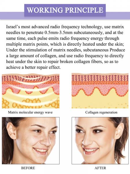 LF-519 High treatment effect microneedle skin tightening machine radio frequency facial equipment