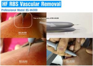 China Professional Vascular Removal Machine , Spider Vein Removal Machine High Frequency wholesale