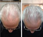 276 diode laser cap hair growing