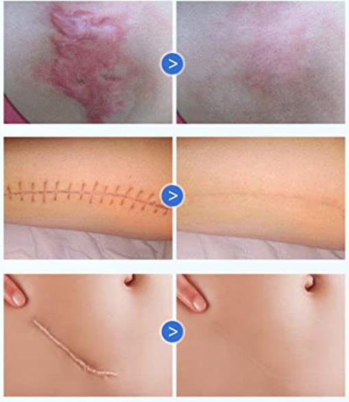 Medical Scar Reducing Emollient Silicone Scar Gel Patches for Scars