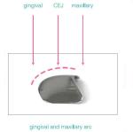 Sectional Matrix Band Dental Use In Teeth M2