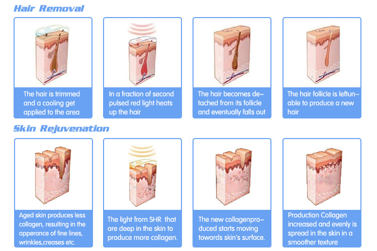 NUBWAY IPL laser/ ipl hair removal machine/fast permanent shr ipl skin rejuvenation