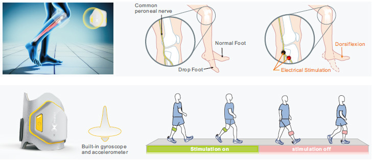 Rechargeable Fes Foot Drop System , Single Channel Foot Nerve Stimulator