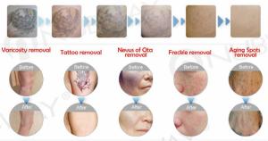 China 1064nm 532 nm 1320nm Q Switched Nd Yag Laser Machine :Pigment removal,Tattoo removal,Skin rejuvenation.Hair removal wholesale
