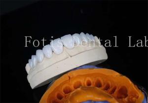 China Porcelain Dental Lab Veneers Bonding Cement For Long Lasting Restorations wholesale
