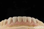 High Translucency Emax Cosmetic Dentistry Veneers High Aesthetics Ultra Thin
