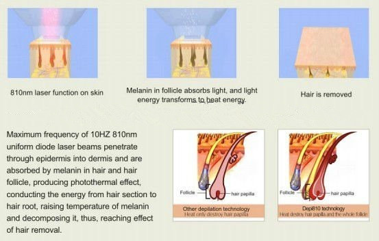 painless 808nm diode laser hair removal permanently