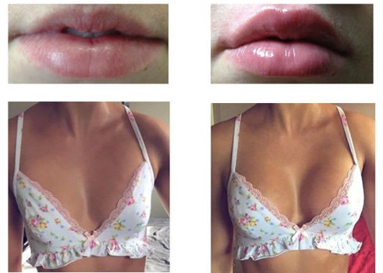 1ml 2ml Injectable Dermal Filler Hyaluronic Acid Lip Filler Face Wrinkle Sodium