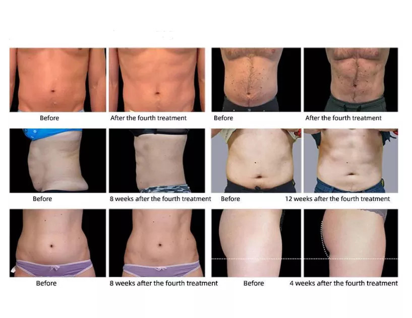 Intensity Electromagnetic Hiemt Muscle Machine Trainer Teslasculpt Body Contouring