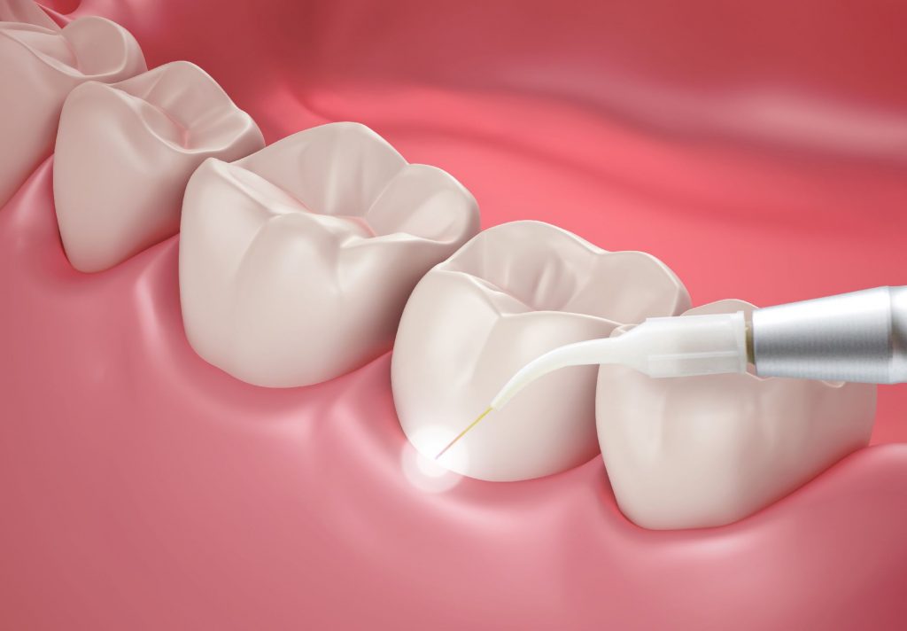15W 980nm Dental Diode Laser Equipment With Disposable Fiber Tips