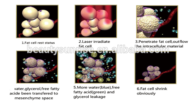 lipo laser.jpg