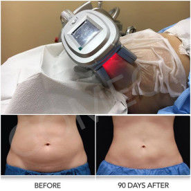 4 Handles Lipo Laser Cryolipolysis Slimming Machine