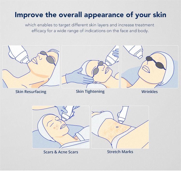 Skin Resurfacing Er Yag Laser Machine Super Penetration Wrinkle Removal Device