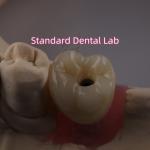 Screw Retained Dental Implant Crown PFZ Porcelain Layered Zirconia