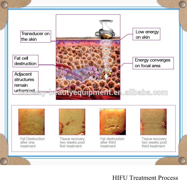 HIFU Treatment Process.jpg
