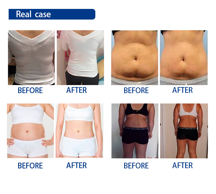 Fat Freeze Cavitation Cryolipolysis Slimming Machine Cellulite Reduce With 4 Handles