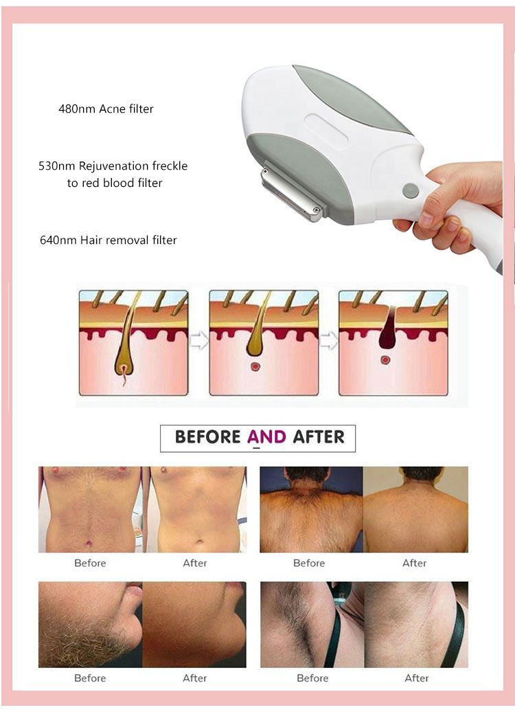 OPT Nd Yag Diode Laser Hair Removal Machine 2 In 1 Picosecond Skin Rejuvenation