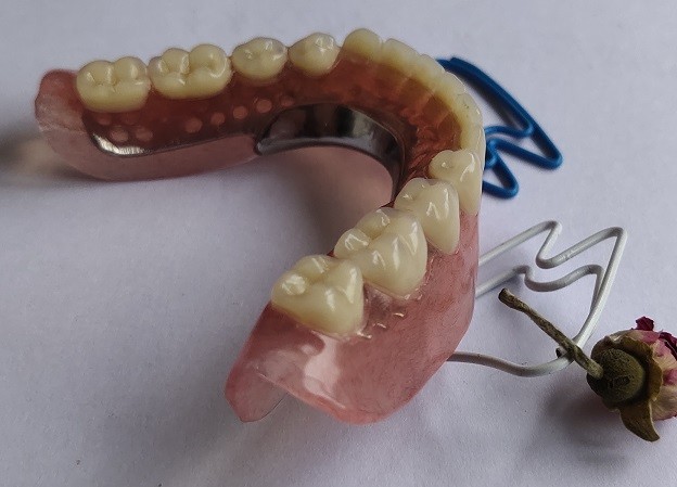 Removable 3D Printed Partial Denture Metal Framework