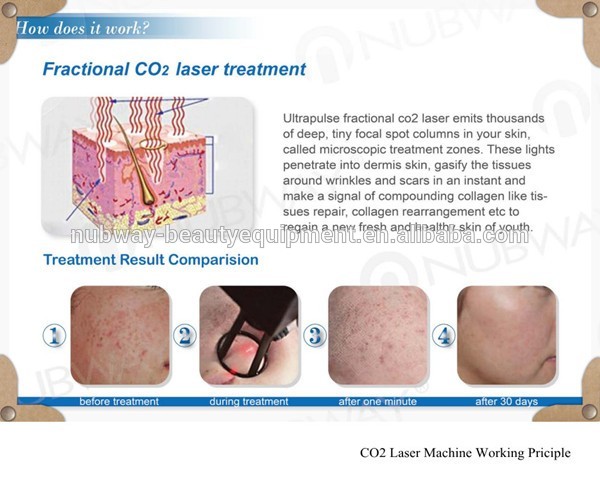 How Fractionla CO2 Laser Work.jpg