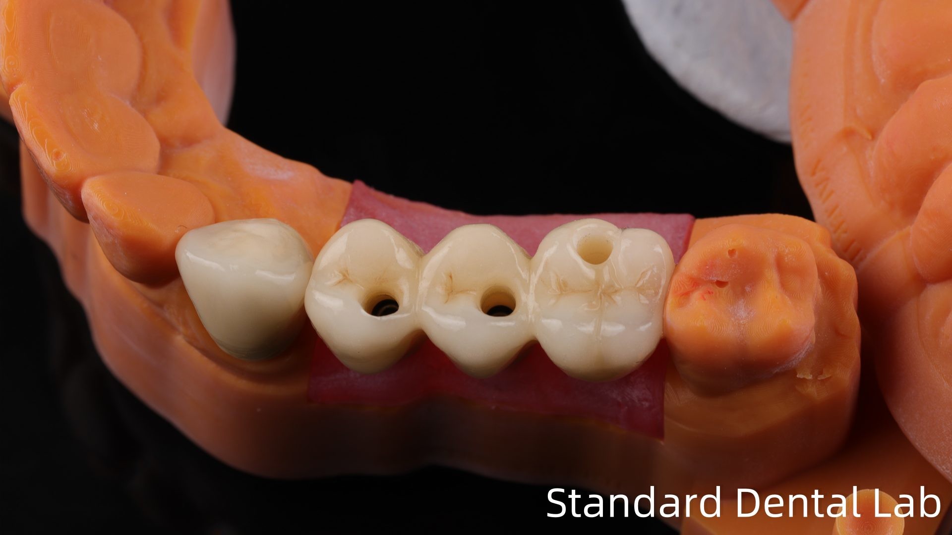 Post Core Dental Lab from China / Metal Post Core with PFM Crown