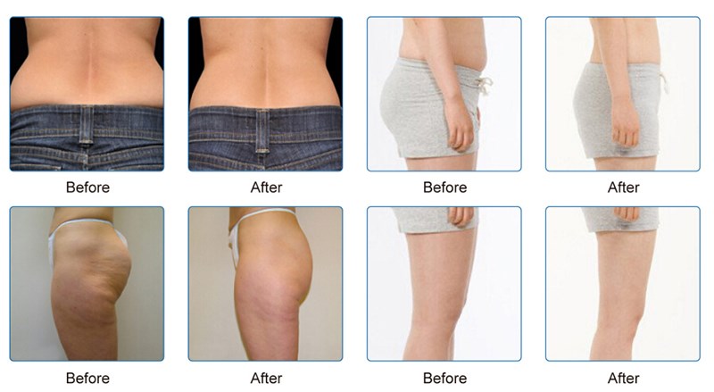 coolscupting zeltiq cryolipolysis fat freezing and shockwave slimming Coolplas vacuum cryotherapy fat freezing