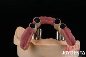 China Dental Precision Attachments Supports Partial Dentures Accurate Restorations wholesale