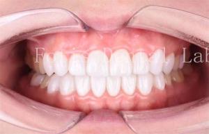 China High Translucency Dental Laminate Veneers Long Lasting Durability Polishing Finishing wholesale