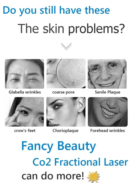 Clinic Salon Portable CO2 Fractional Laser Machine Beauty Salon Equipment For Acne Removal
