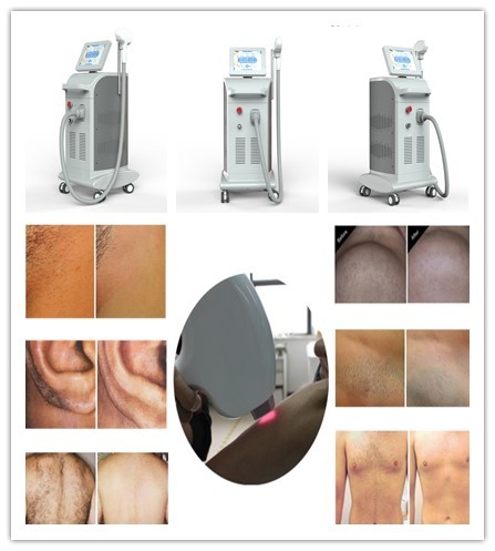 Professional triple wave length laser hair removal 755/808/1064nm diode laser