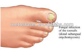 Professional 1064nm 10Hz desk-top toenail fungus laser machine