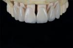 Dental Natural Porcelain Teeth Veneers Feldspathic Veneer 0.5mm-0.7mm