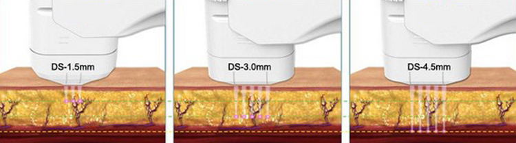 4MHz 11 Lines HIFU Machine with 8 Cartridges for Wrinkle Removal and Anti-aging