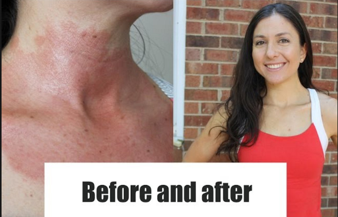 UVB Phototherapy Light Therapy Treatment For Psoriasis
