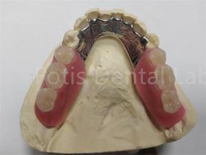 China OEM Flexible Removable Partial Denture Easy To Clean / Maintain wholesale