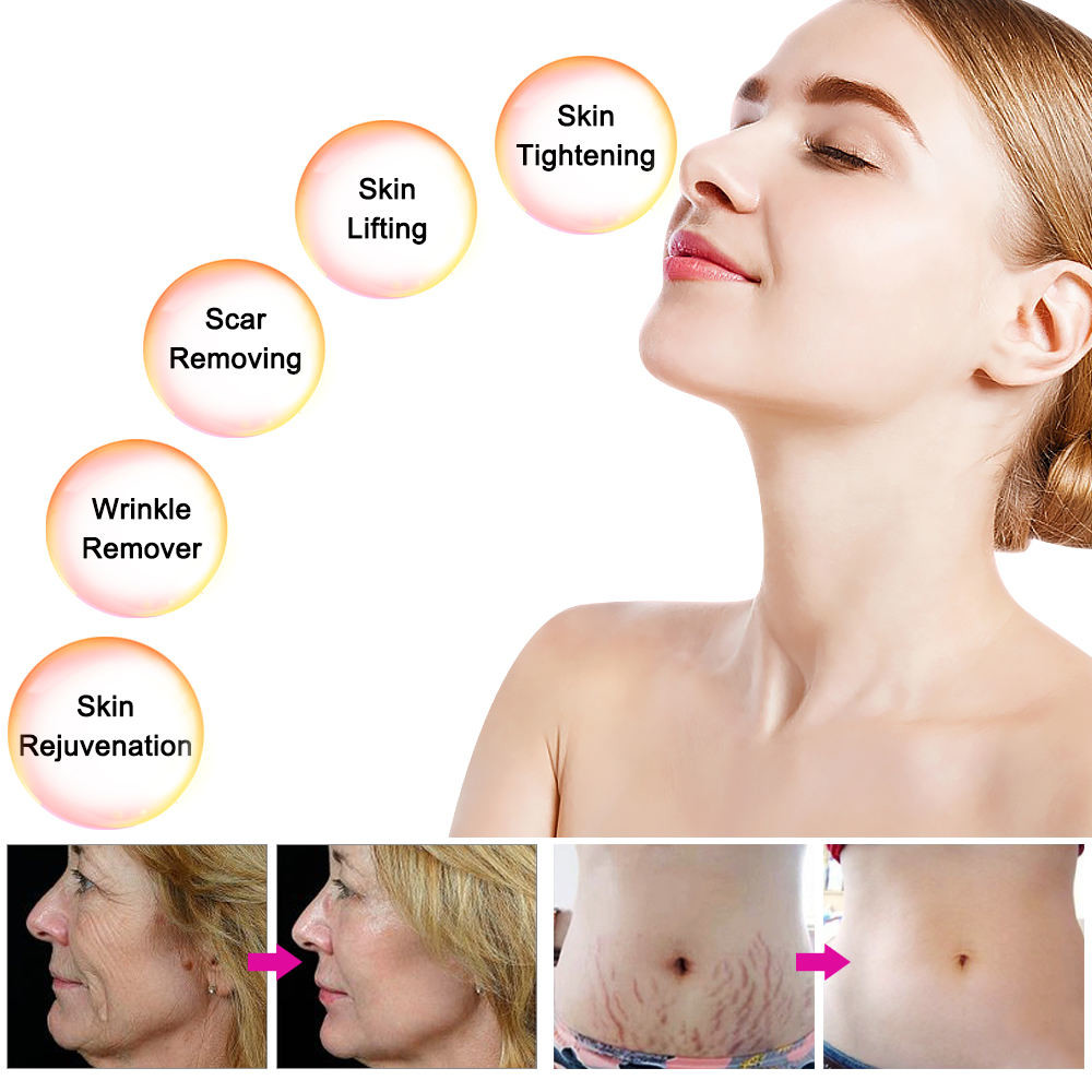 64 Pins Nano Microneedle Fractional RF Machine Acne Scar Removal