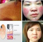 Factory direct sale! spider vein treatment