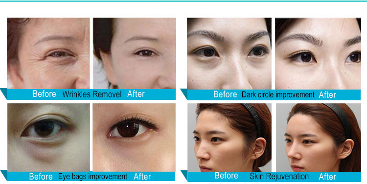 RF System Eye Care Machine Anti wrinkle Massage Device with Infrared Light