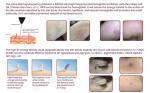 high frequency safety rbs laser spider vein removal machine for wart