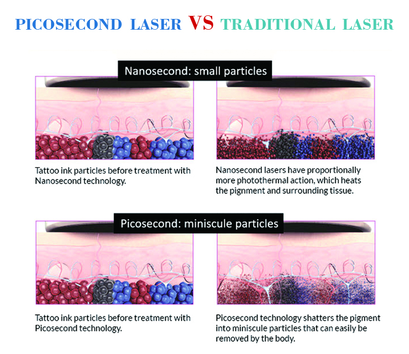 picosecond laser.jpg