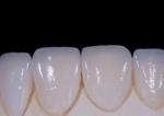 EMAX Durablity CAD/CAM Dental Composite Veneers Highly Detailed Accurate
