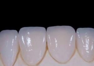 China EMAX Durablity CAD/CAM Dental Composite Veneers Highly Detailed Accurate wholesale