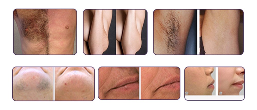 Diode Laser Hair Removal Machine triple wavelength lady hair removal machine