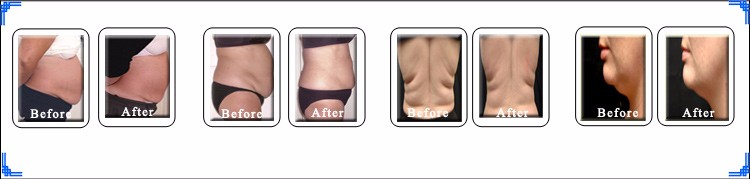 cryolipolysis-weight-Loss-4-handles-fat-freezing-slimming .jpg