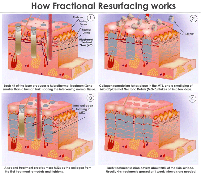 Tightening Skin Fractional CO2 Laser Beauty Machine For Acne Pigment Scar Removal