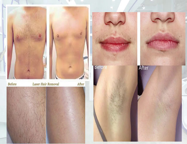1000000 Shots IPL Hair Removal Machine