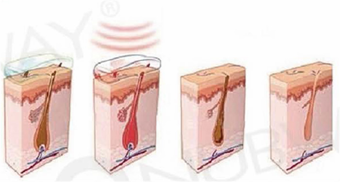 Painless SHR IPL Hair Removal Machine NUBWAY