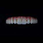 Full Coutour Arch Zirconia Fixed Dentures Crown Biocompatible Material