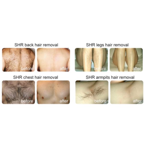 3 In 1 SHR IPL Hair Removal Machine Yag Laser Tattoo Removal Machine