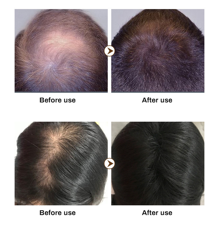 300 ML Private Label Oil Control Natural Plant Hair Growth Anti Hair Loss Shampoo