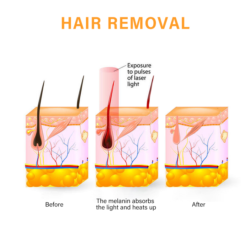 Epilator Clinical Diode Laser Hair Removal System Stationary Diode 808 Laser Machine